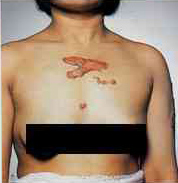 From About Cancer Website (Chest Keloid)
