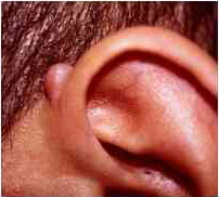 From About Cancer website (Ear)