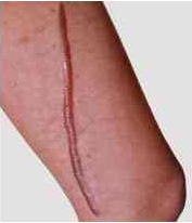 From About Cancer website (Leg)
