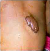 From About Cancer website