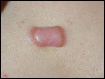 Image from Dermatology.co.uk