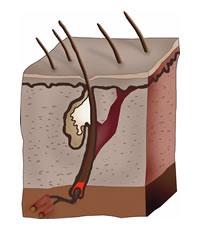 Hair transplantation today