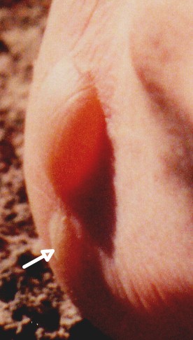 blister2.jpg