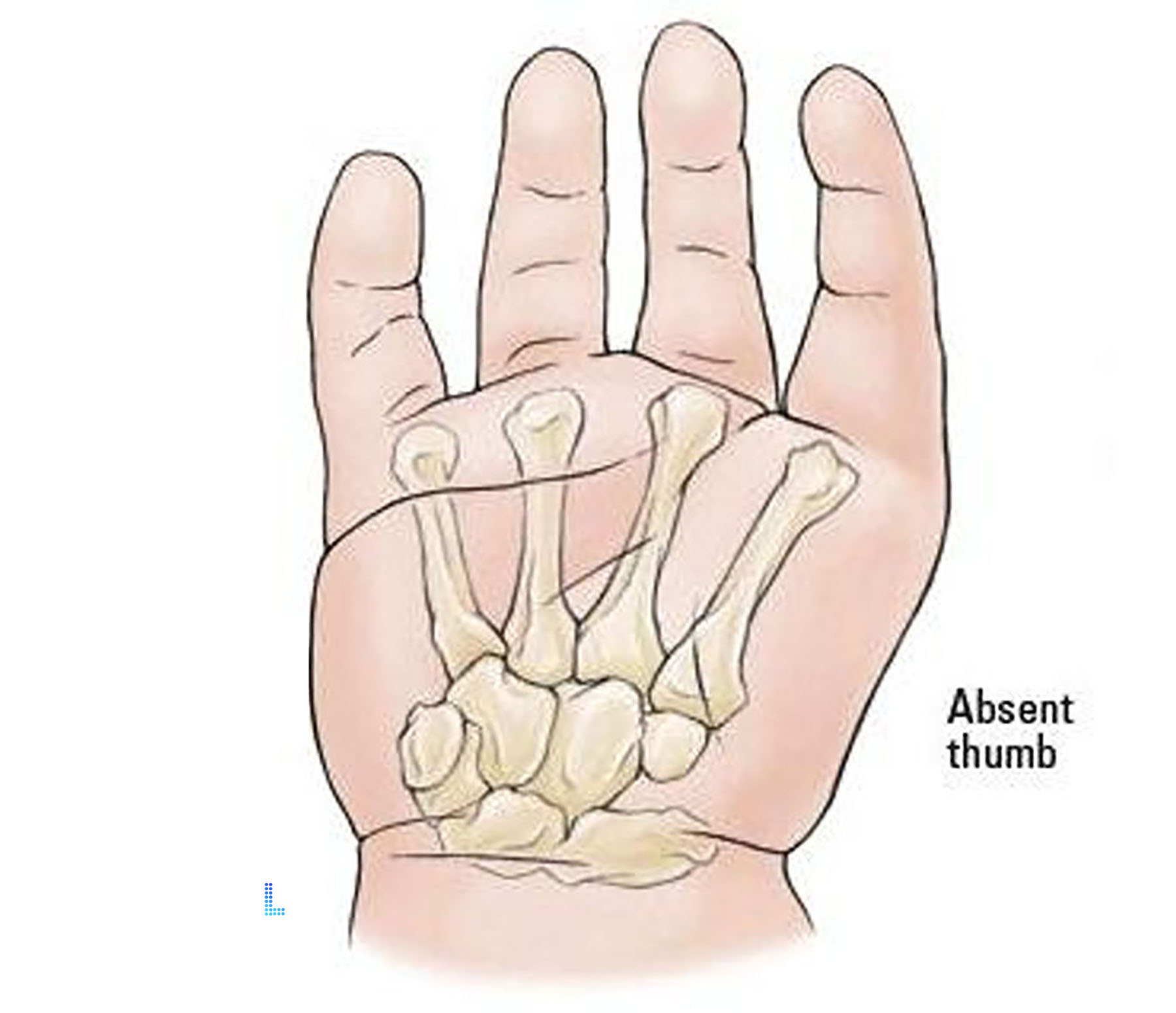 Absent thumb Patient Satisfaction with Plastic Surgery in Lahore