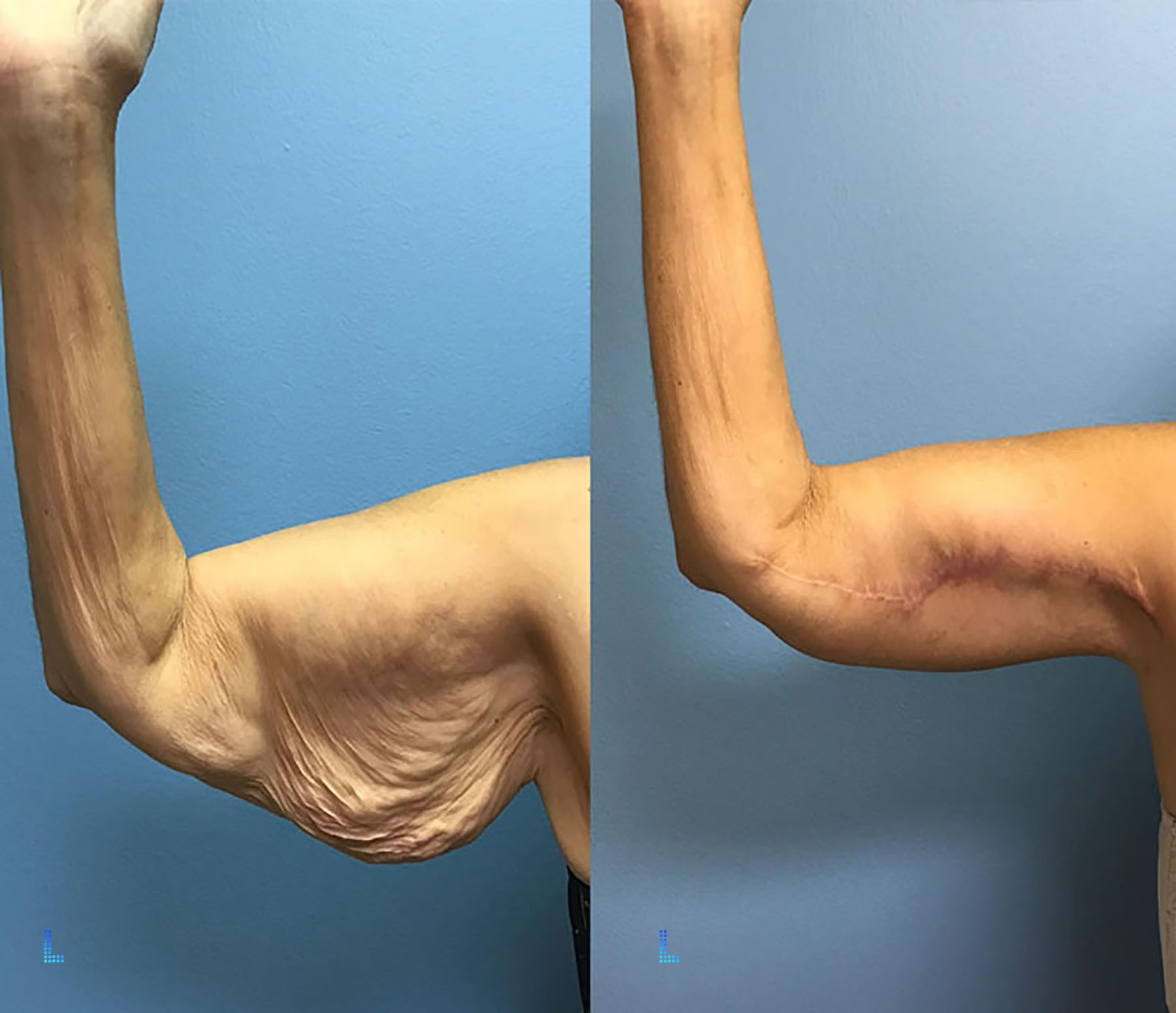 Best Aesthetic Arm Lift Surgery in Lahore