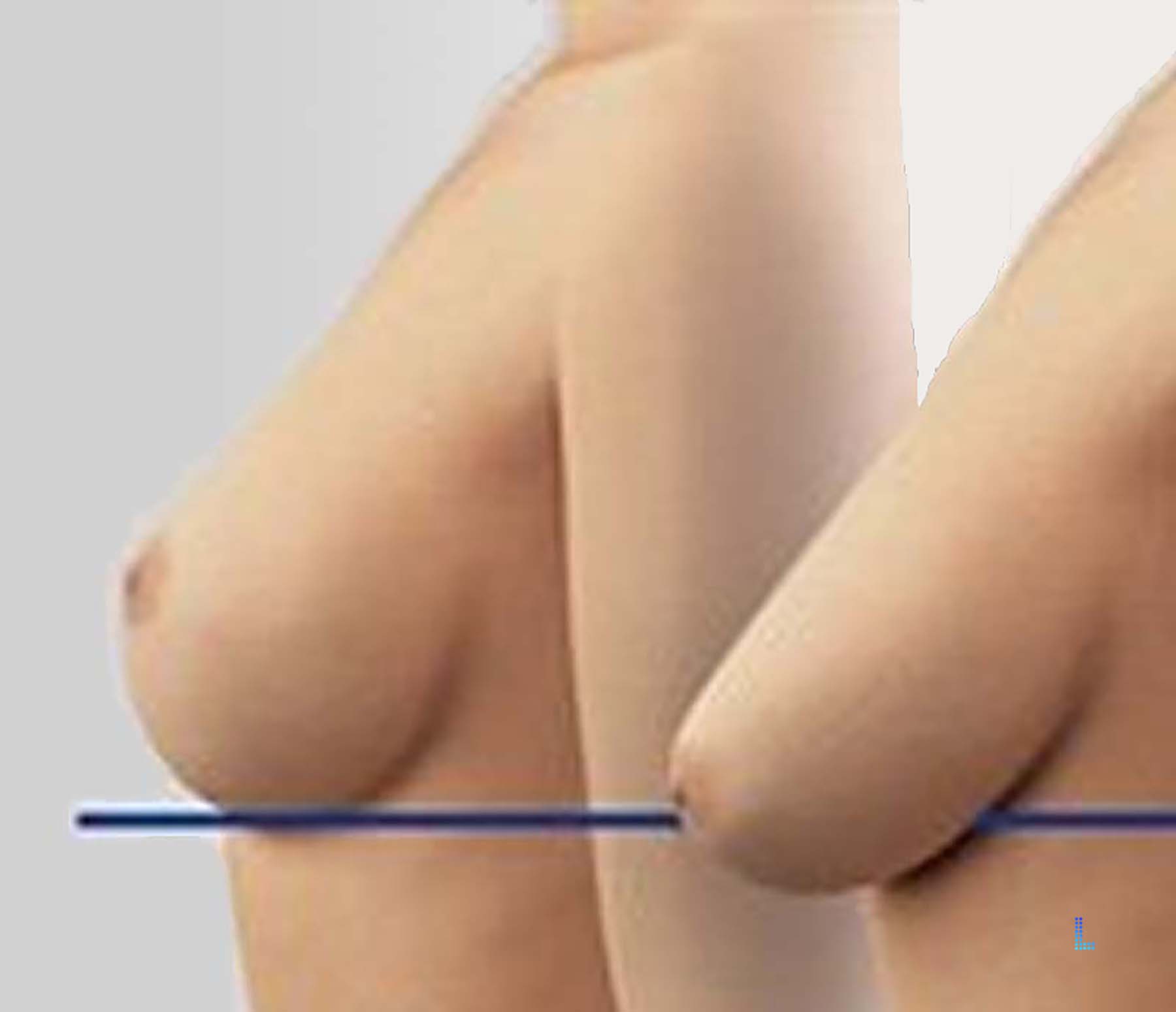 Best Cosmetic  Breast Lift and Mastopexy  in Lahore