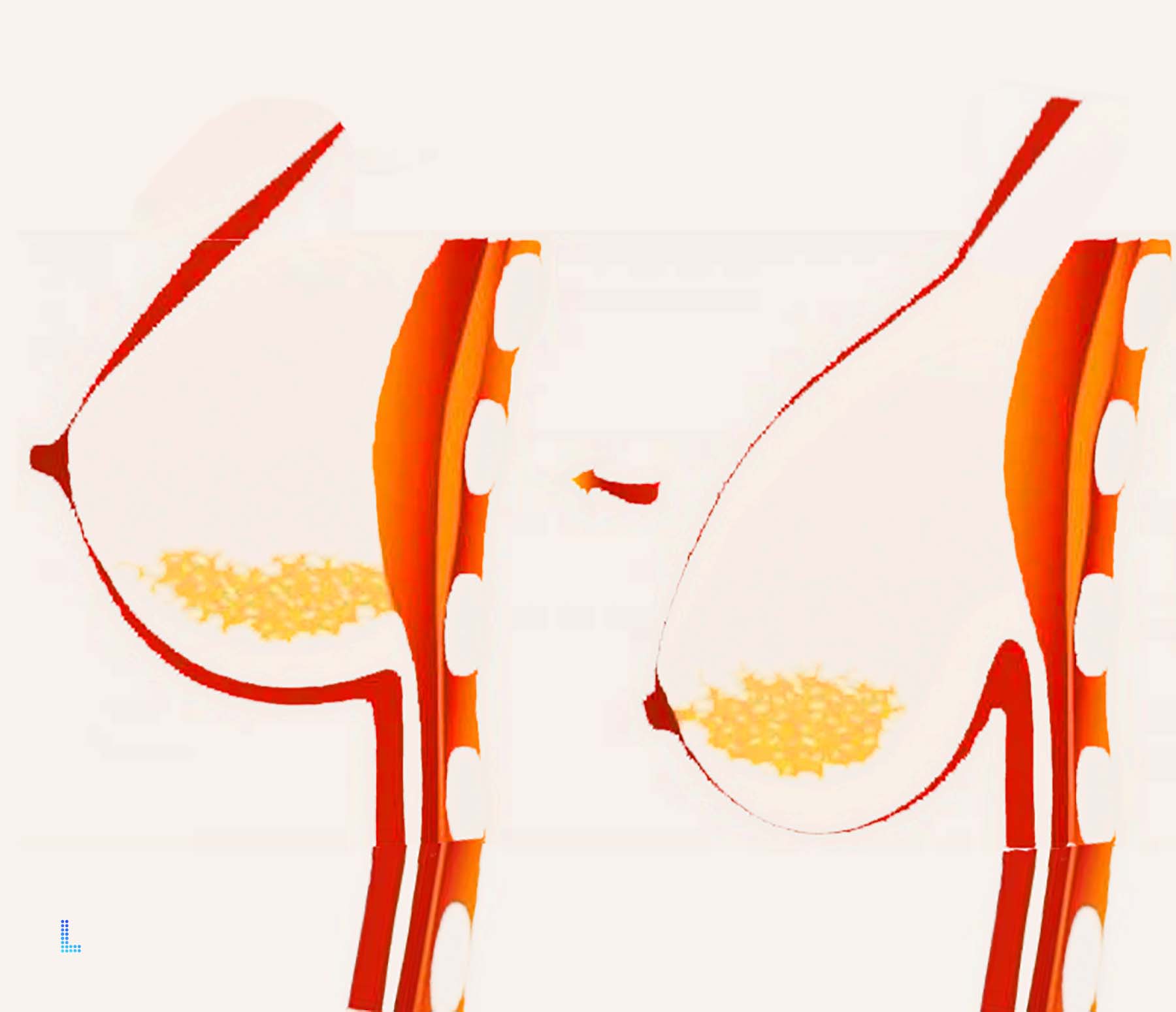 Best Aesthetic Breast Lift and Mastopexy  in Lahore