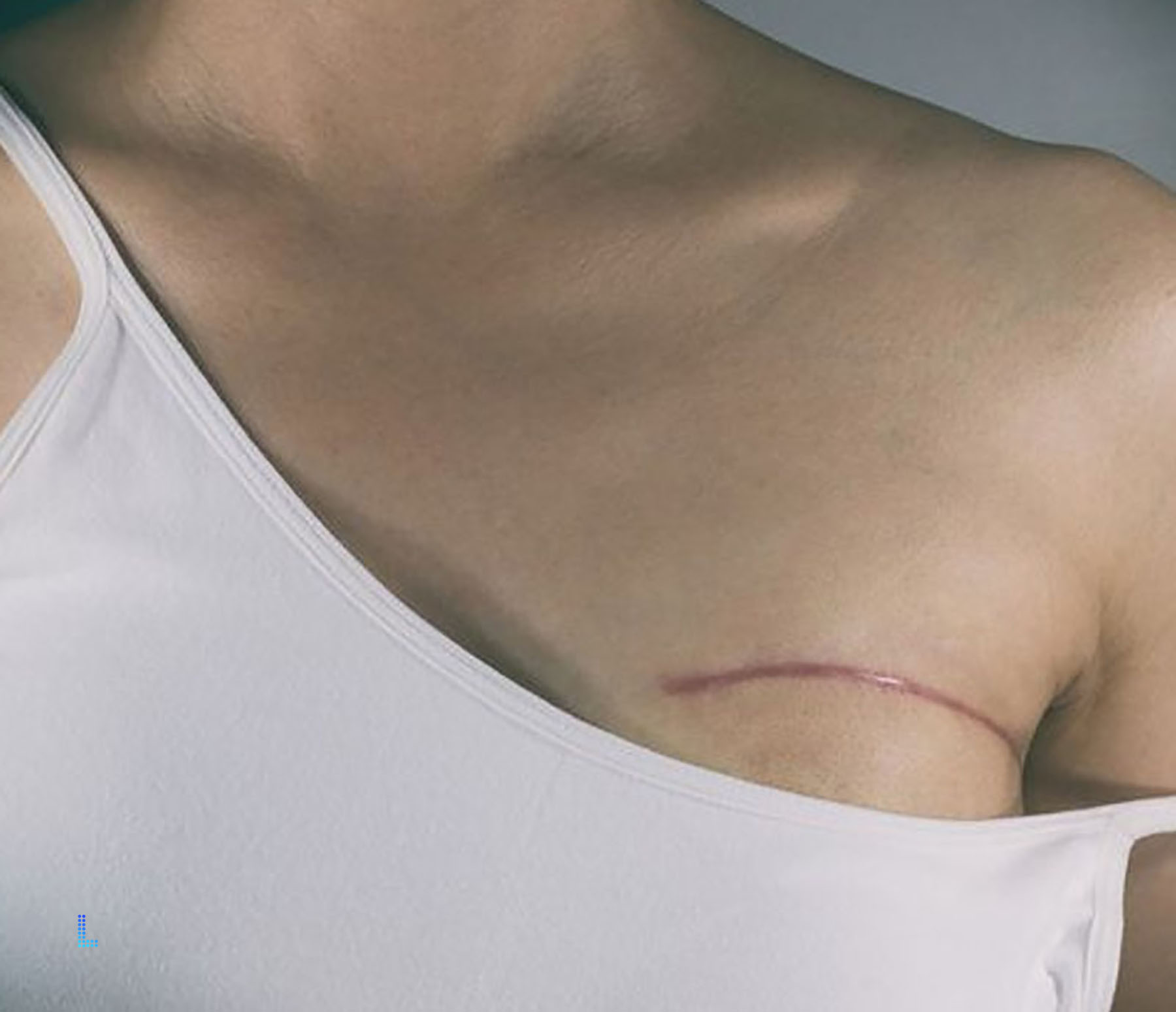 Ideal Patients for breast reconstruction Lahore