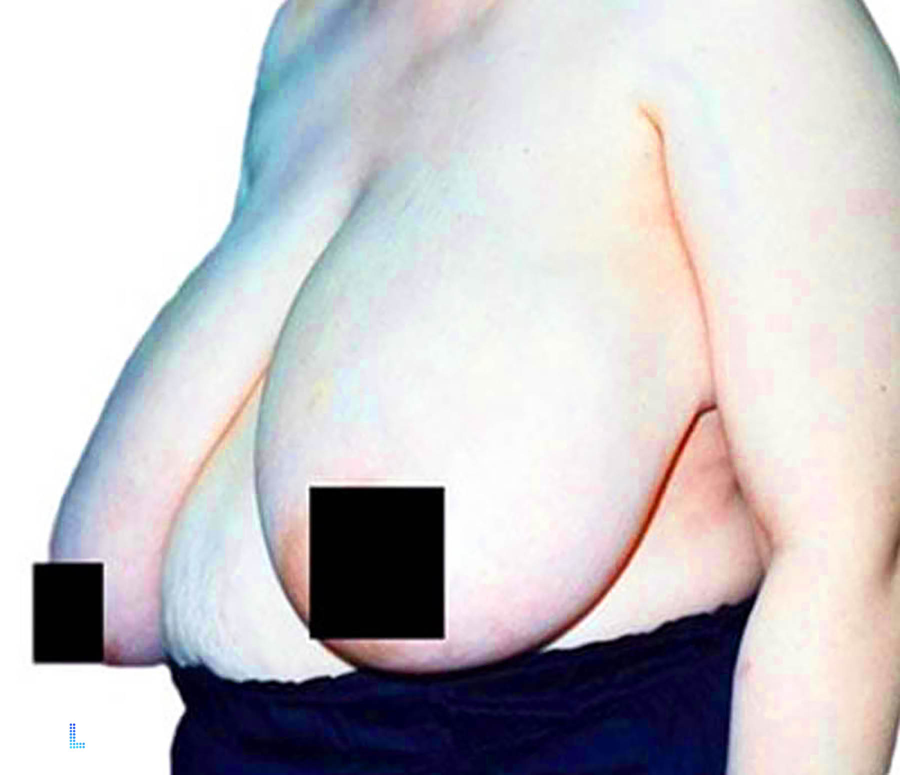 Ideal Patients for breast surgery