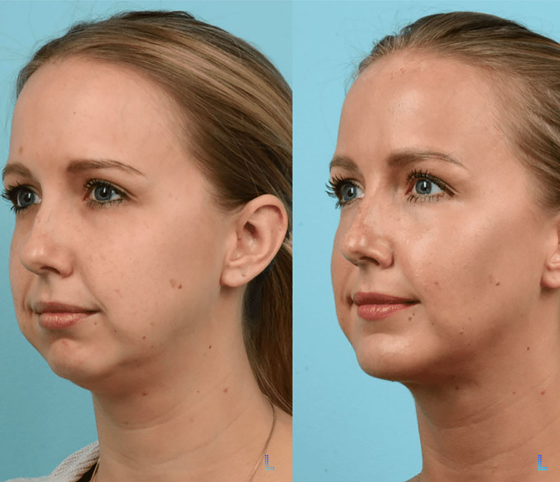 Cheek Fat Removal in Lahore Plastic Surgeryur