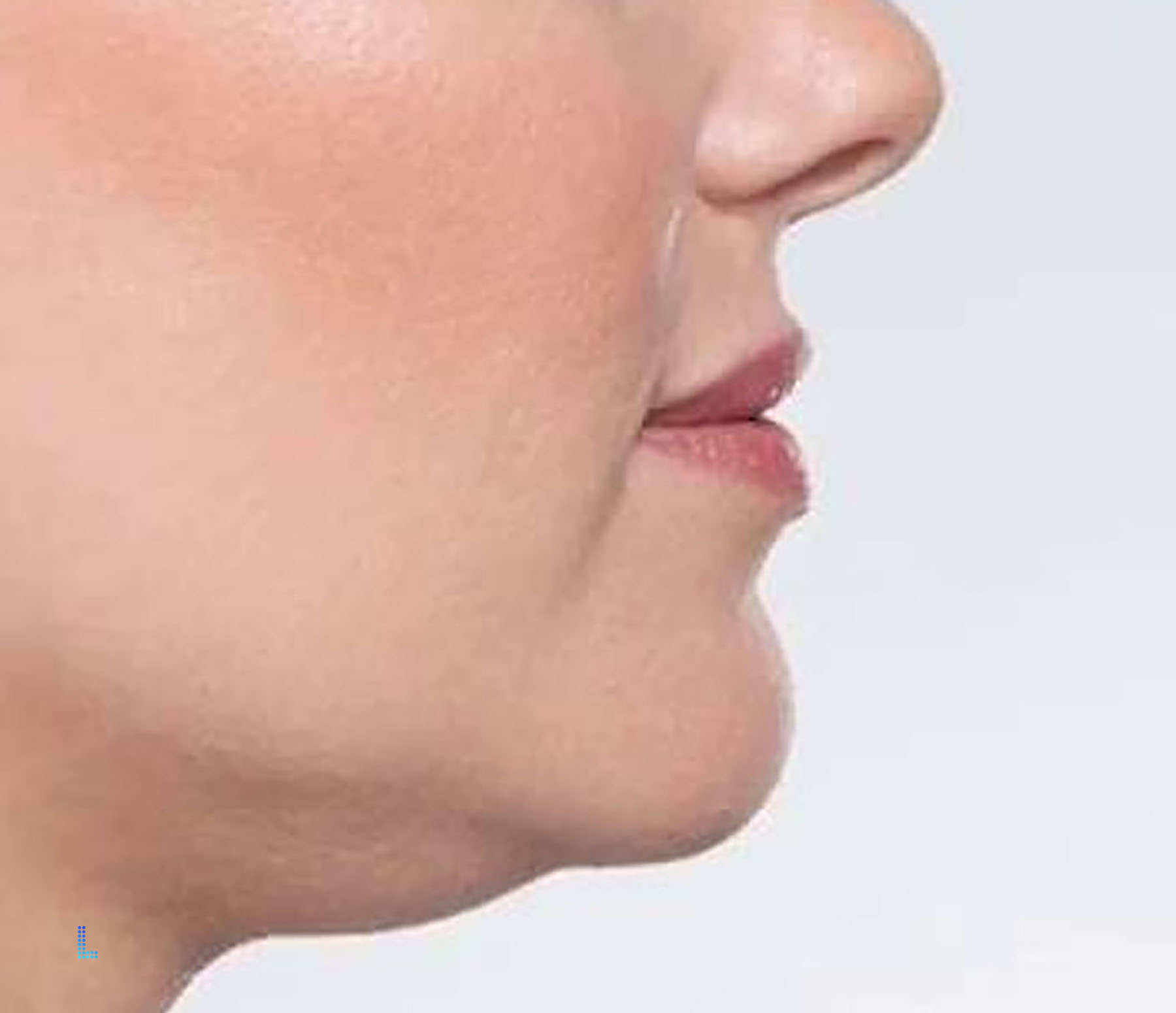 Best Aesthetic  Double Chin Removal in Lahore