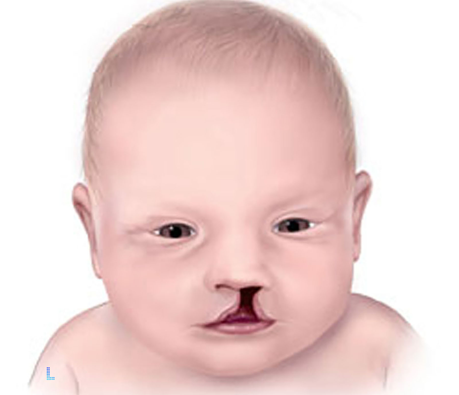 Defects by Birth