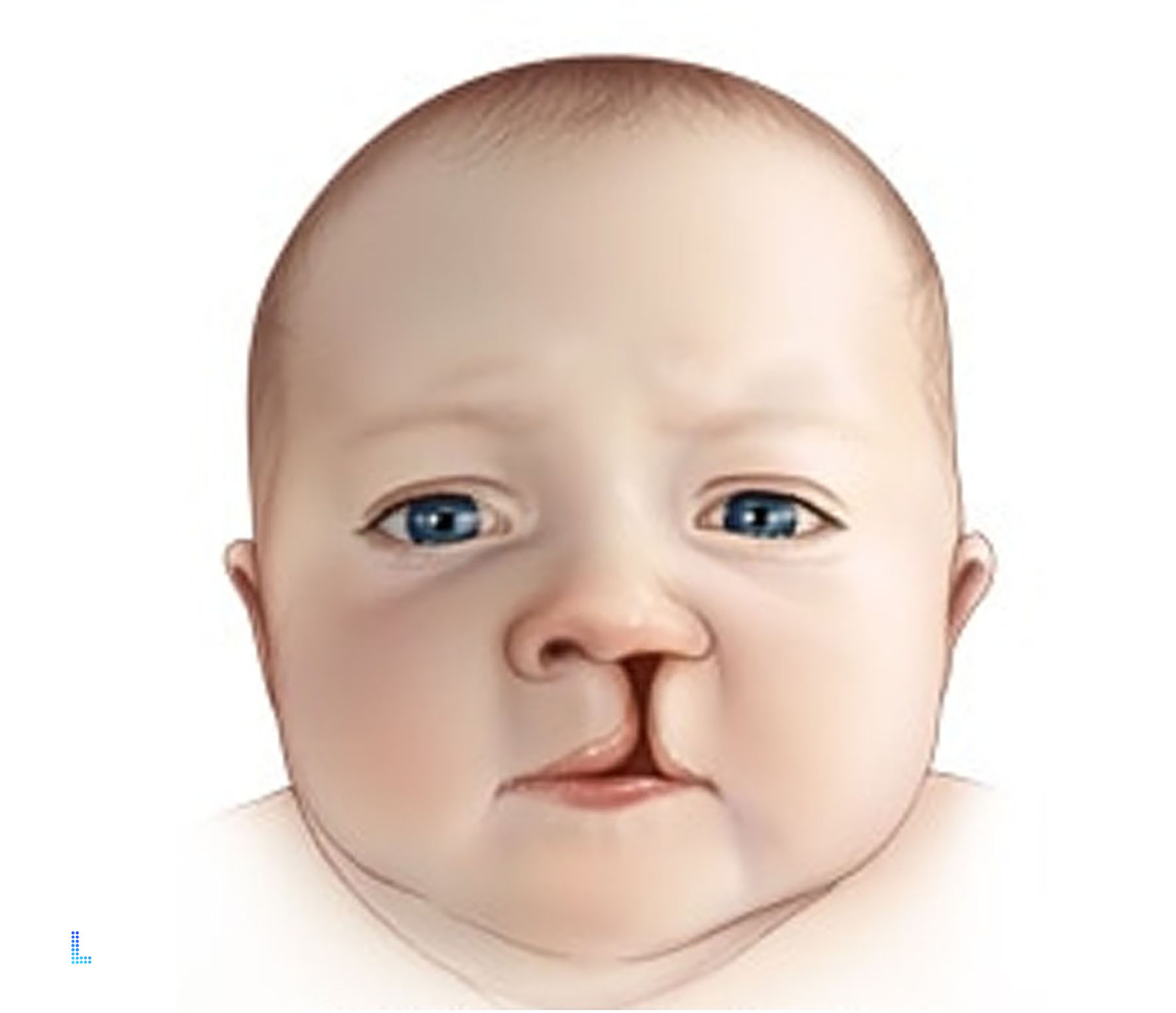 Best Cleft Lip in Lahore