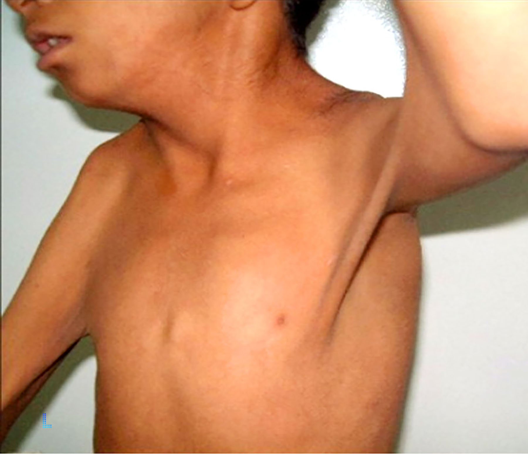 Contractures