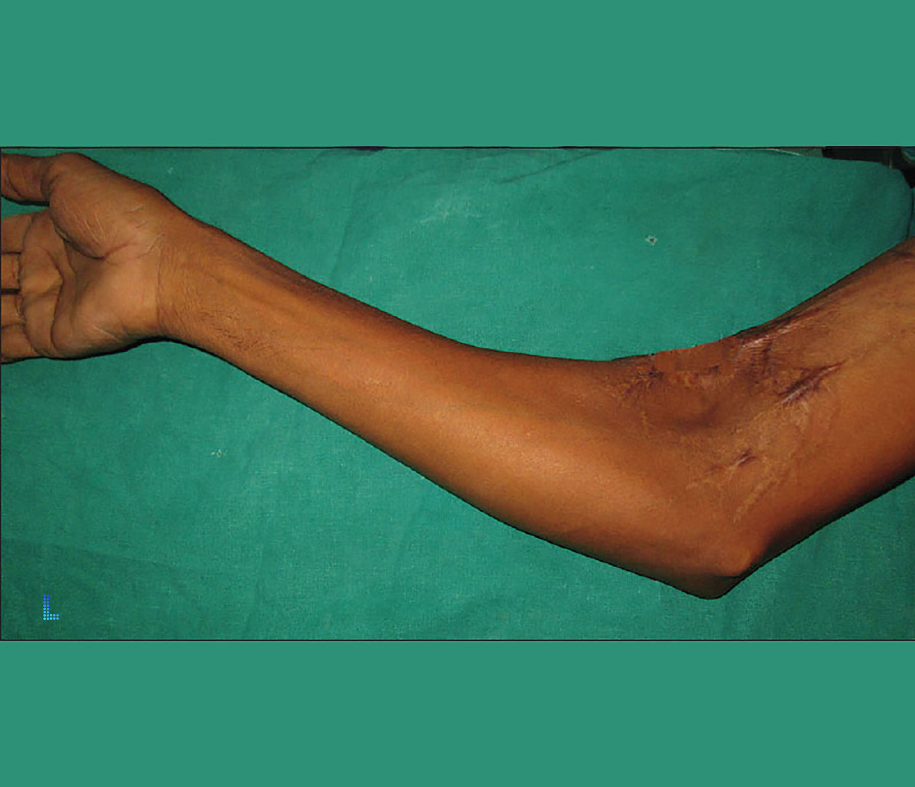 contracture Ideal Patients Lahore