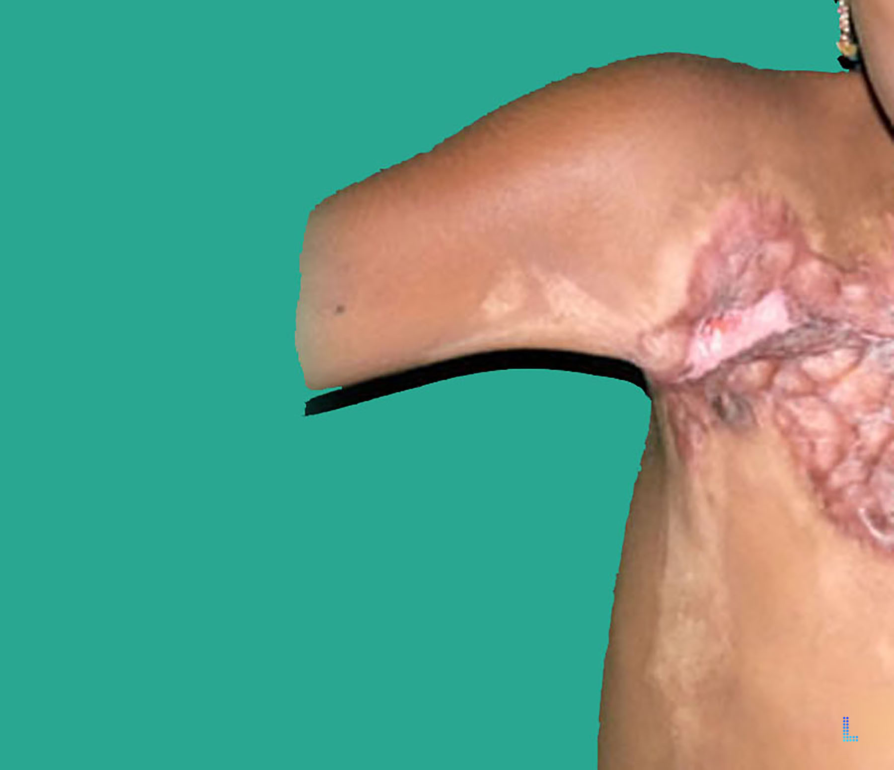 Patient Satisfaction with Plastic Surgery contracture
