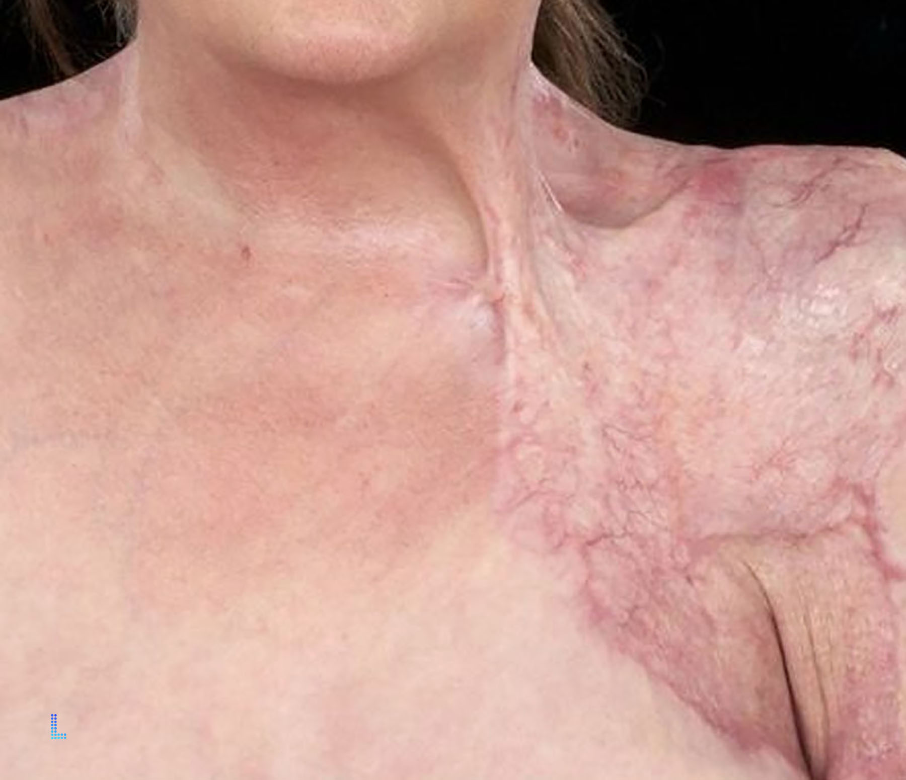 Follow Ups of contracture Surgery