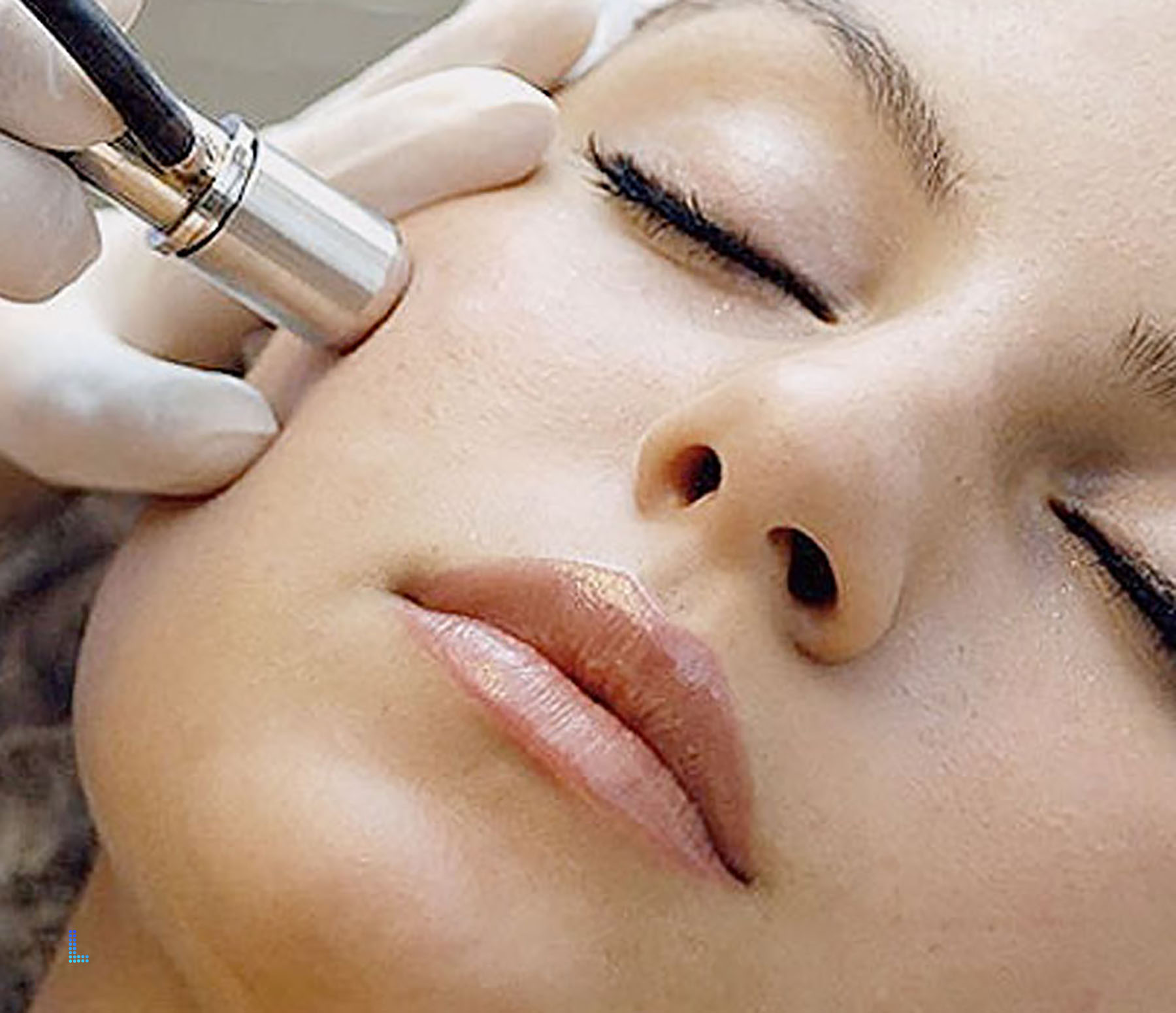 Detail Dermabrasion Procedure in Lahore