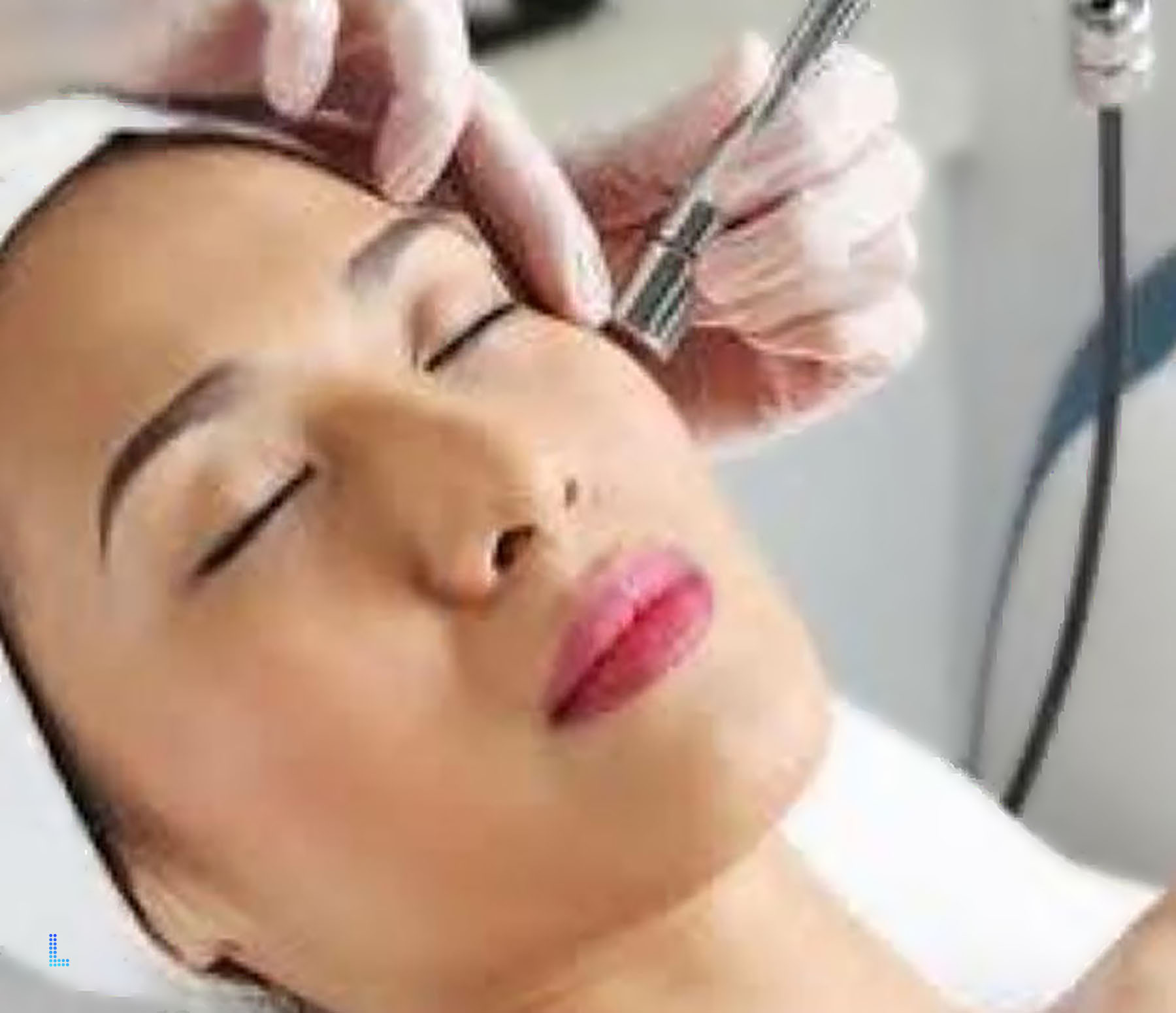 Derabrasion for Skin Rejuvination Procedures to do in Lahore