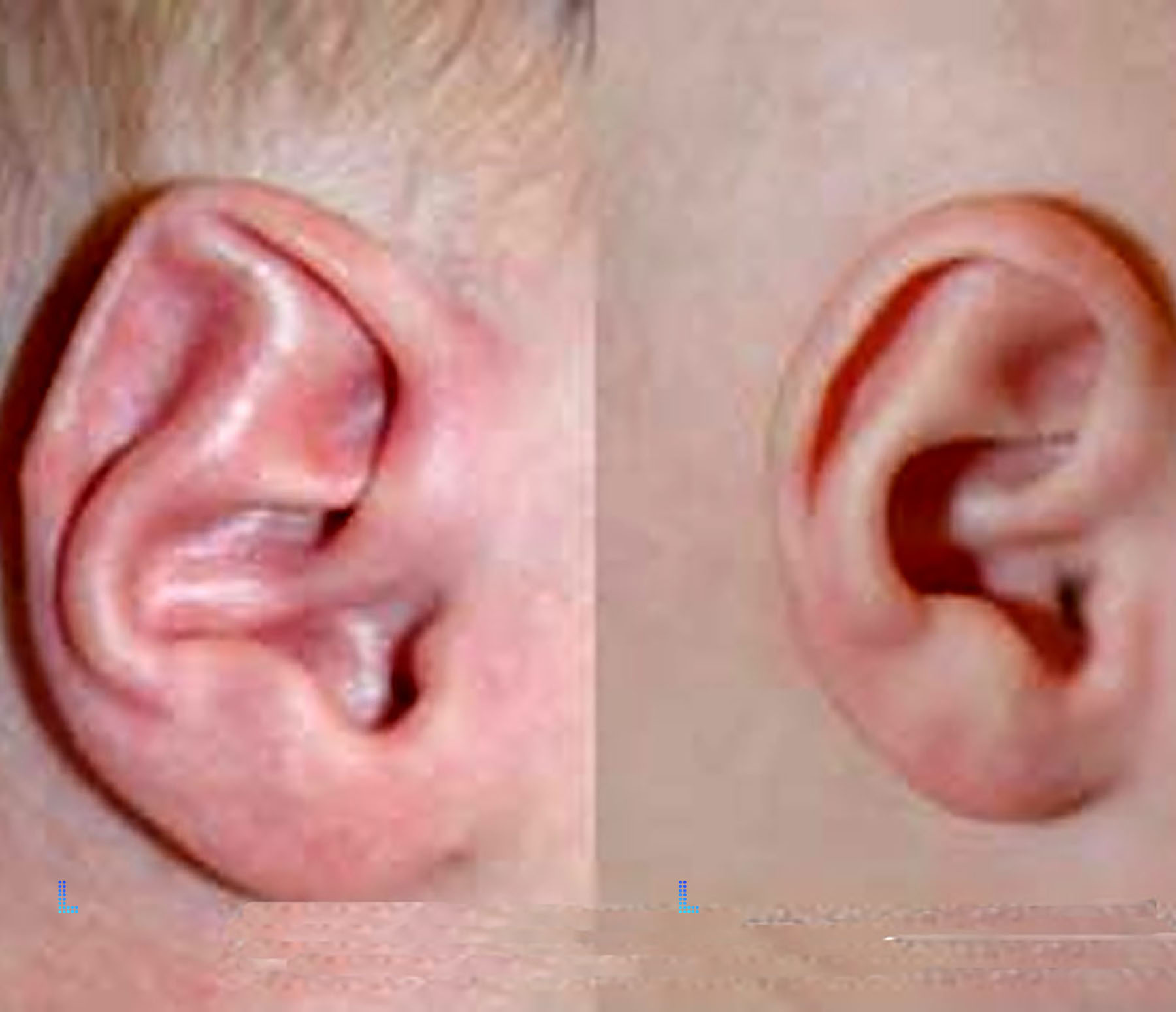 Best Cosmetic ear corrction in Lahore