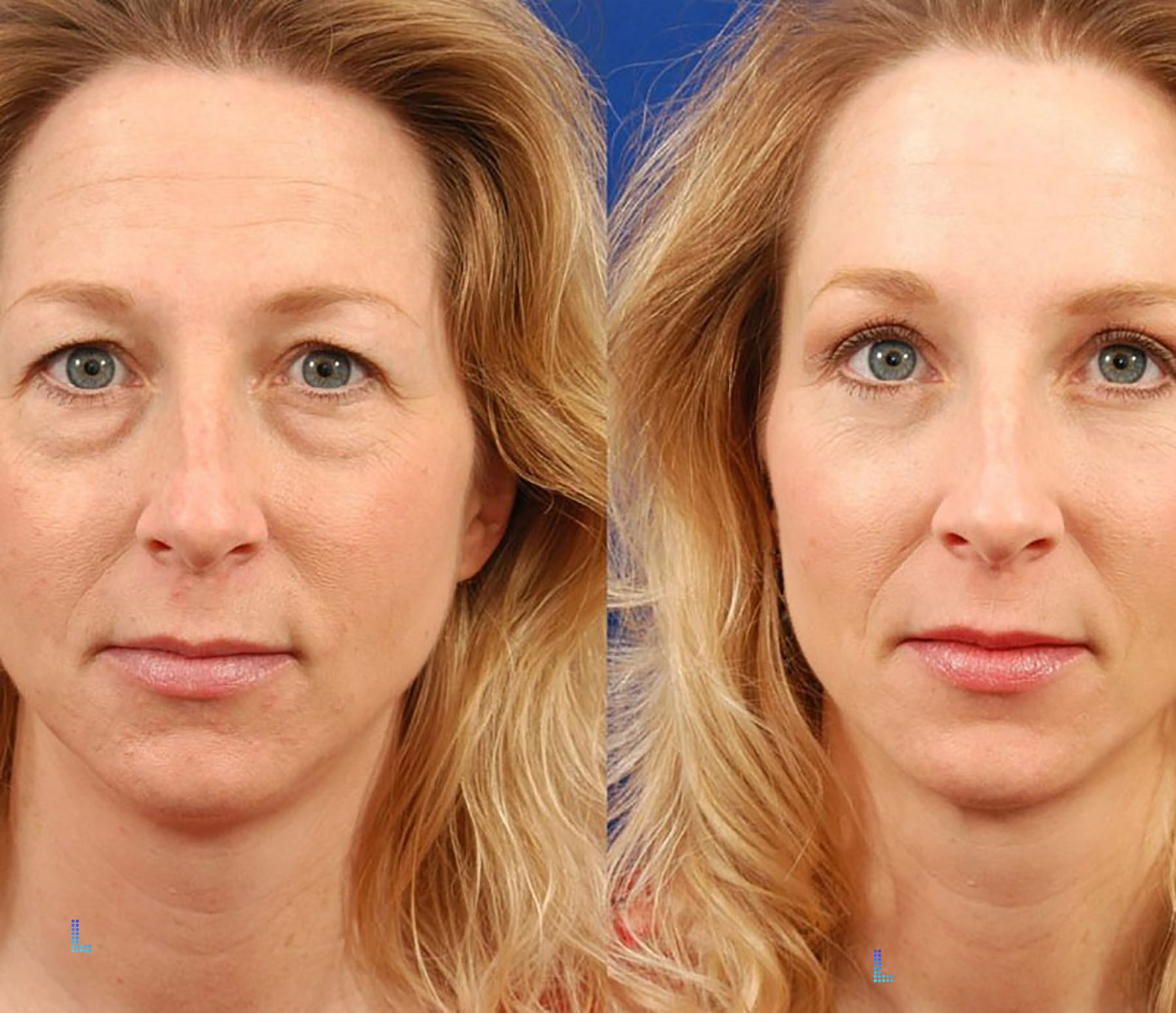 Detail of Eye lid surgery or Blaphroplasty Procedure in Lahore