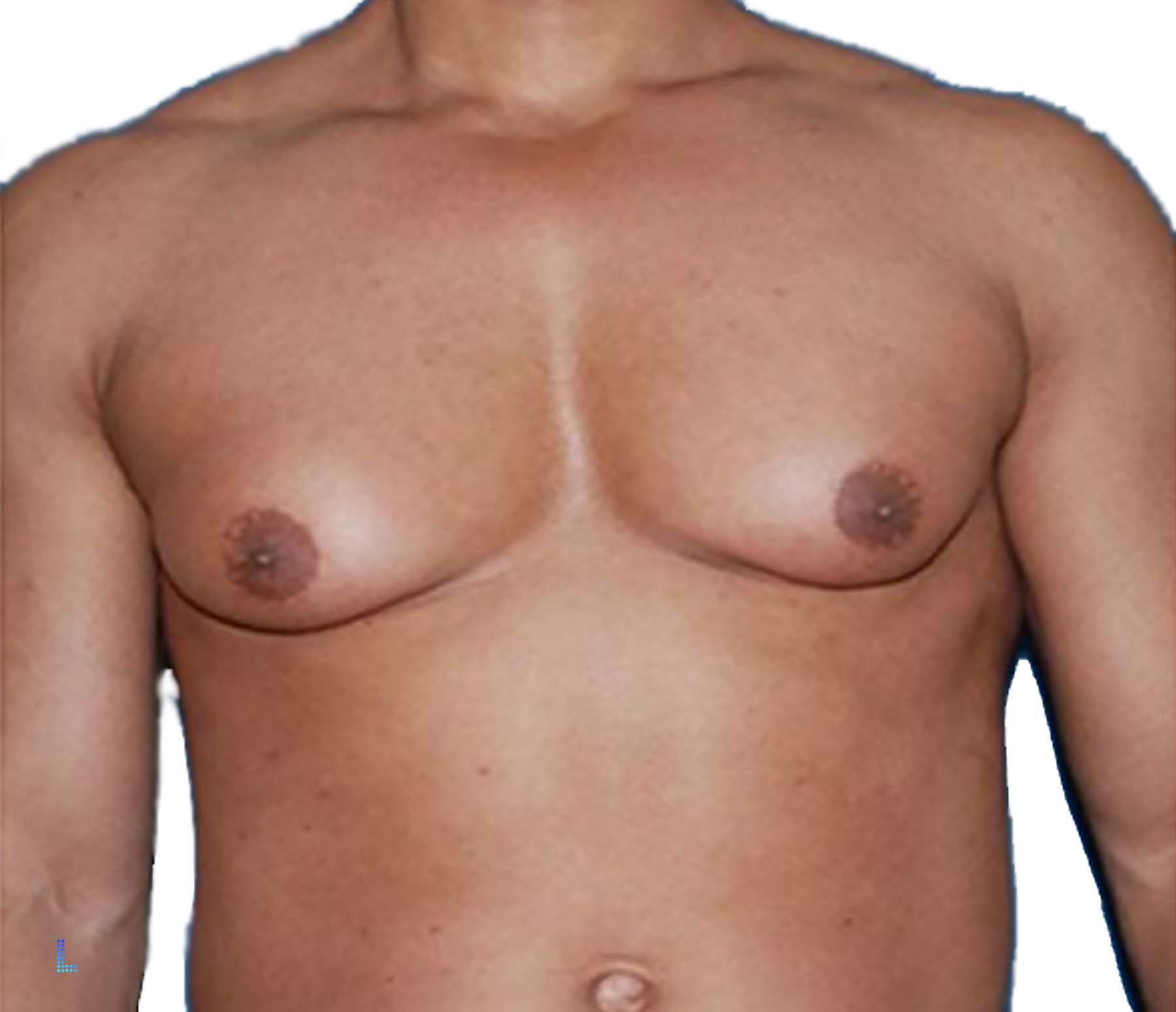 Male boobs Lahore