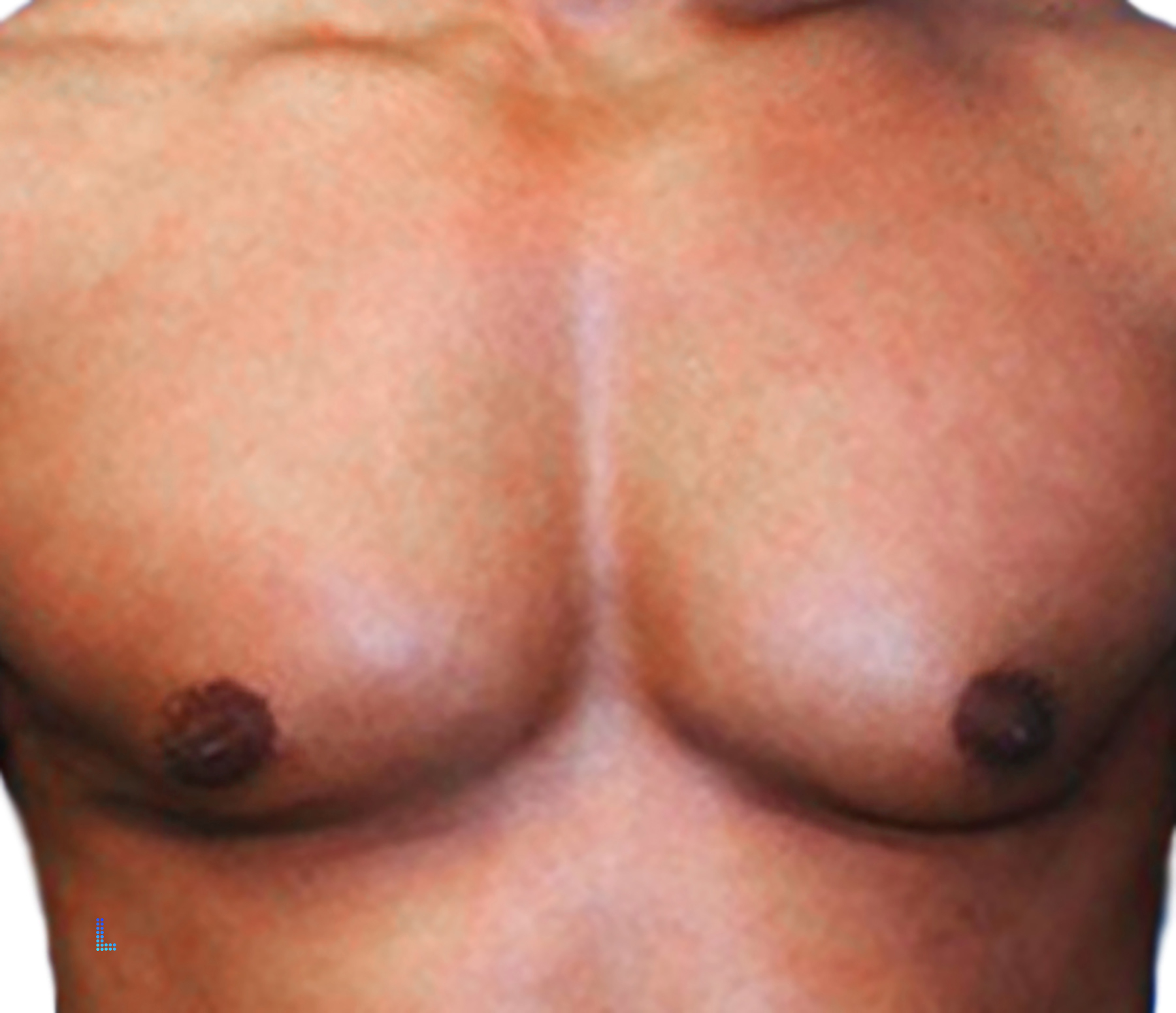 Ideal Patients Gynecomastia or Male Breasts Lahore