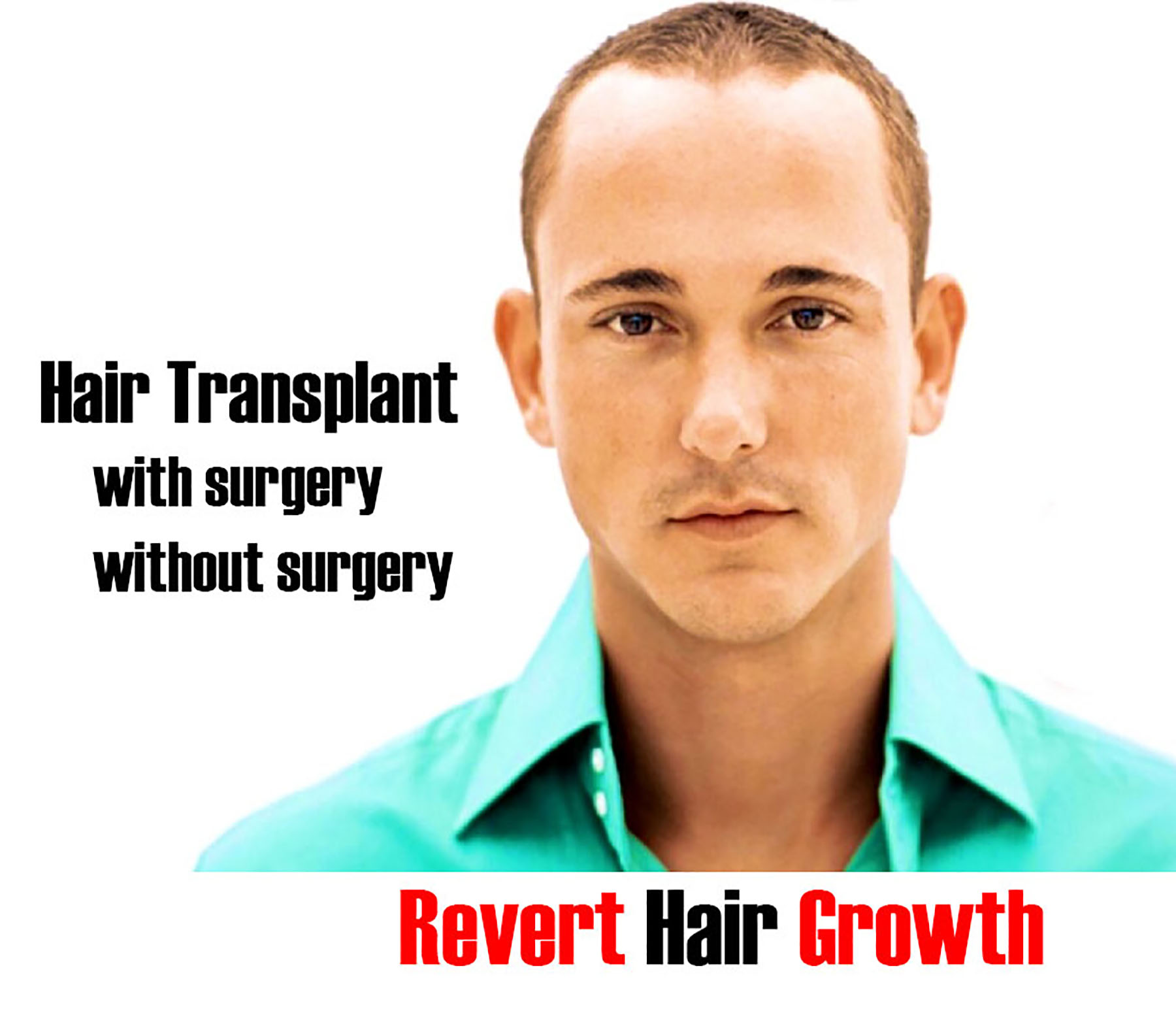 Best Non Surgical Hair Transplants FUE in Lahore