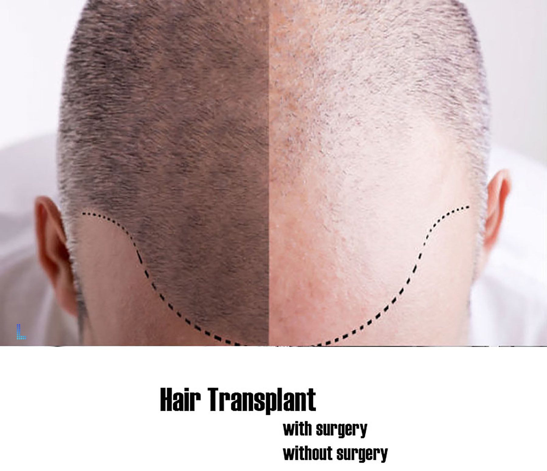 Best Non Surgical Hair Transplants FUE in Lahore