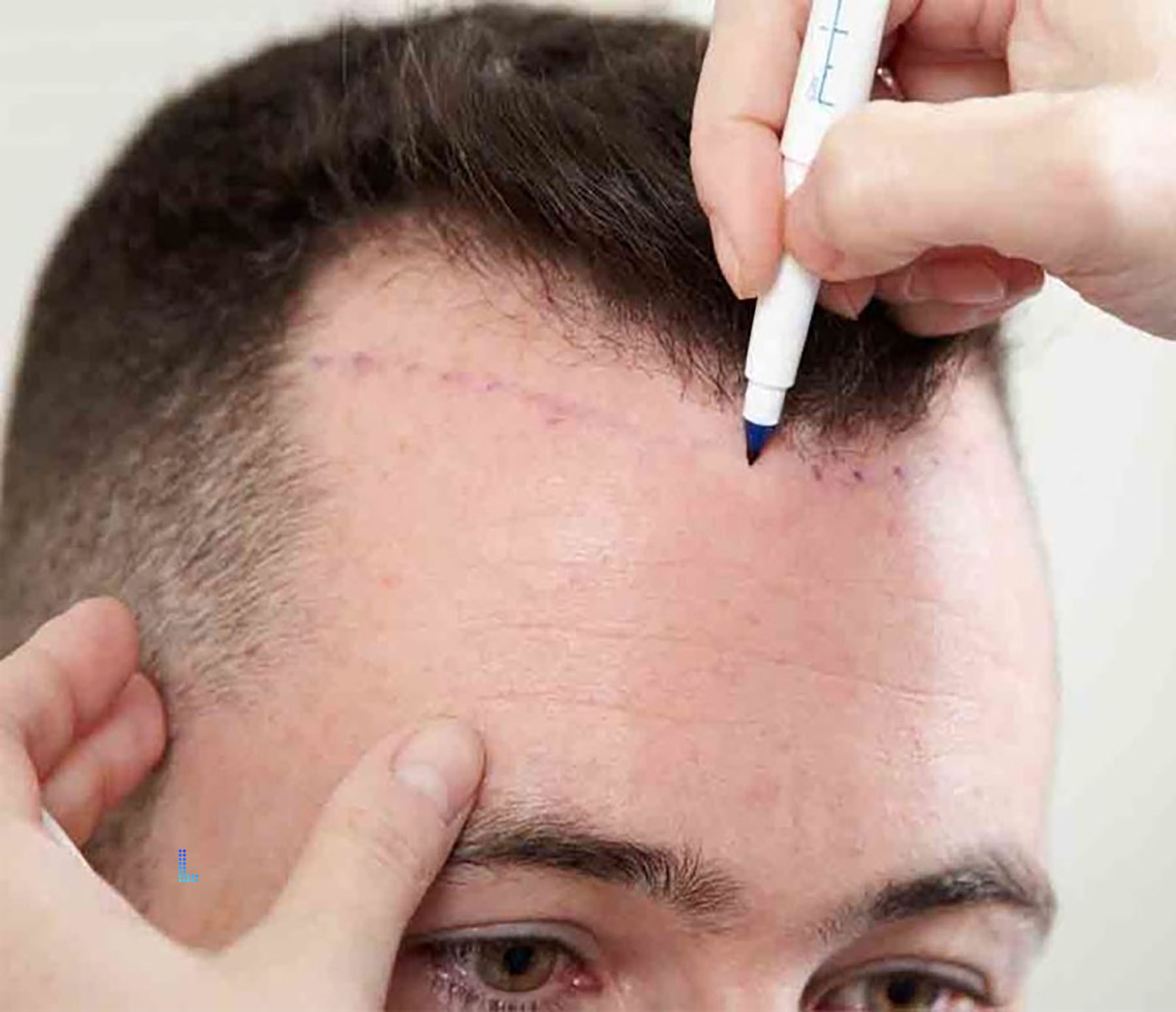 Best  Surgical Hair Transplants Surgery FUT in Lahore