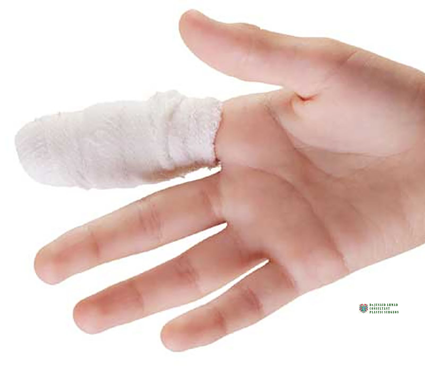 Hand Trauma treated by Dr Junaid Ahmad Plastic Surgeon
