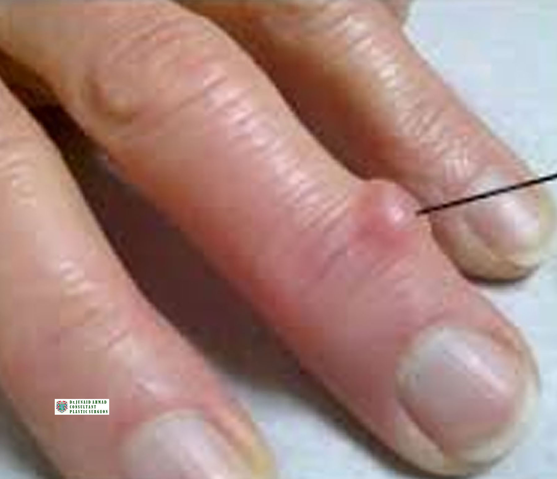 Patient Satisfaction with Plastic Surgery in Lahore after tokka machine injury or hand tumors