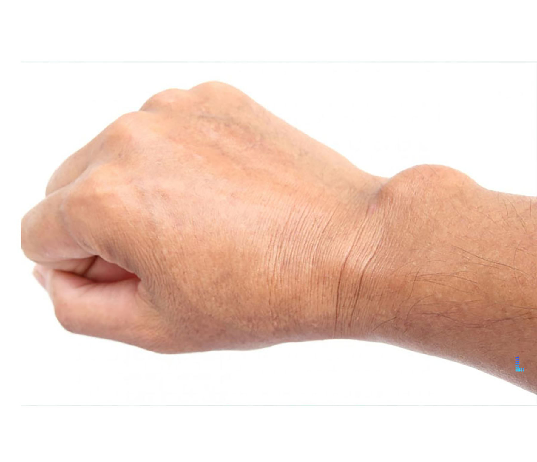 Hand Tumors treated by Dr Junaid Ahmad Plastic Surgeon