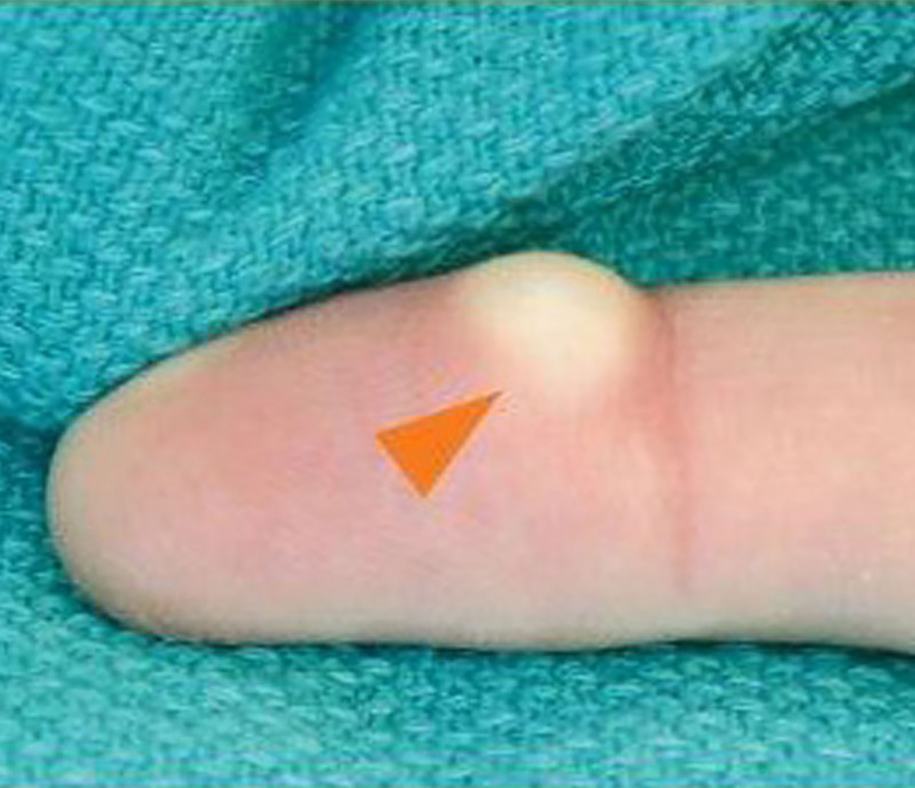Follow Ups of hand Plastic Surgery
