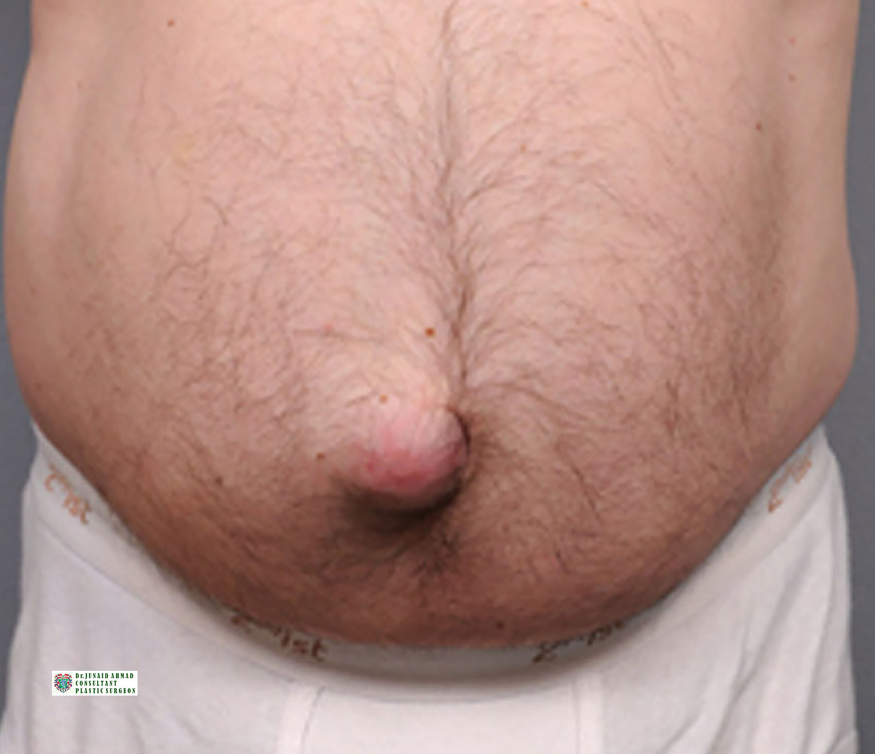 Ideal Hernia Patients Lahore