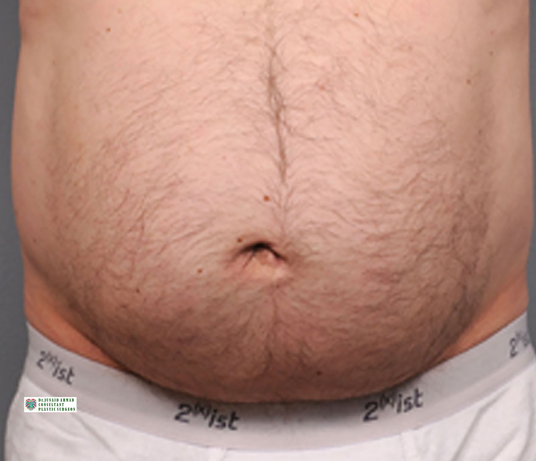 Follow Ups of Cosmetic Hernia Plastic Surgery