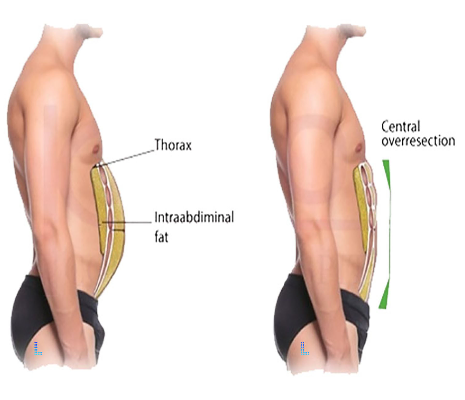 Liposuction