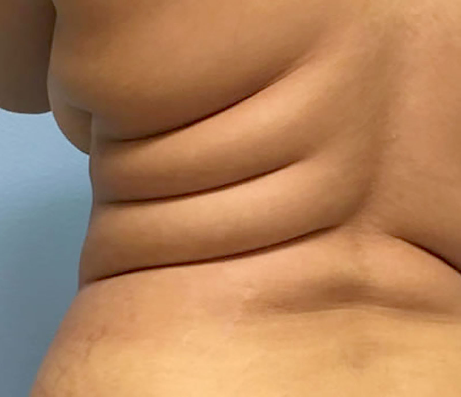 Patient Satisfaction with Liposuction Plastic Surgery in Lahore