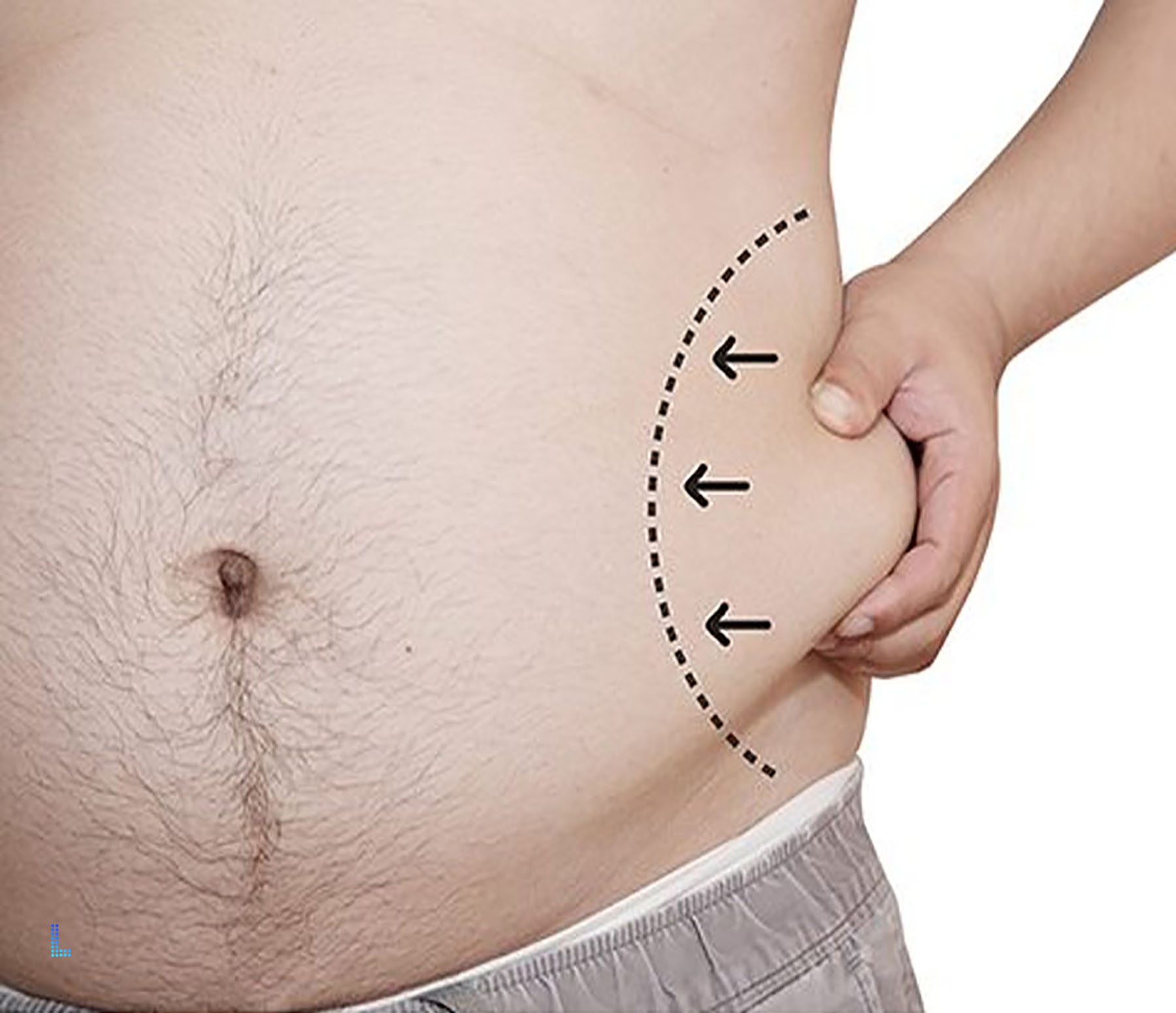 Common Procedures Liposuction to do in Lahore