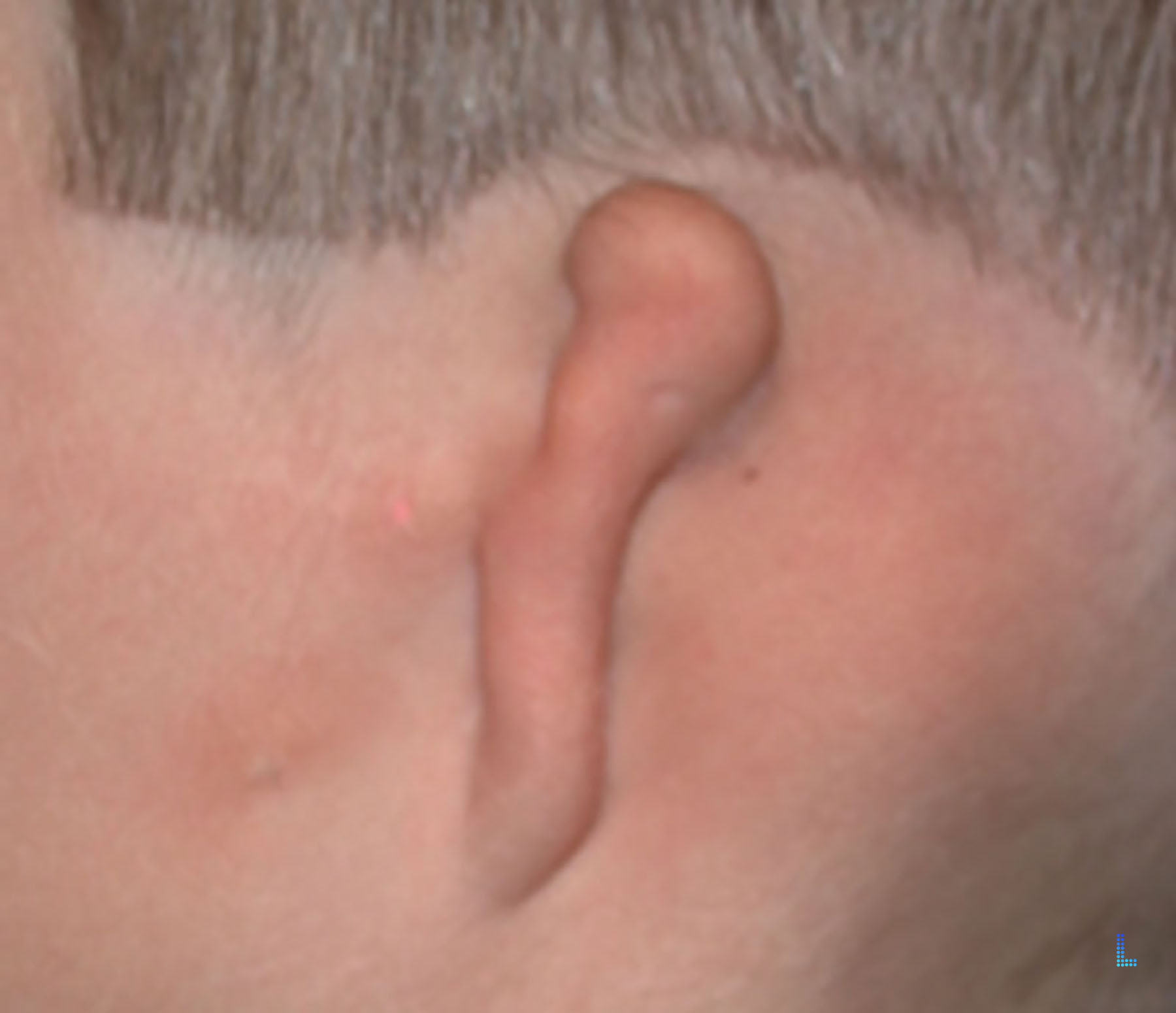 Small Ear Plastic Surgery