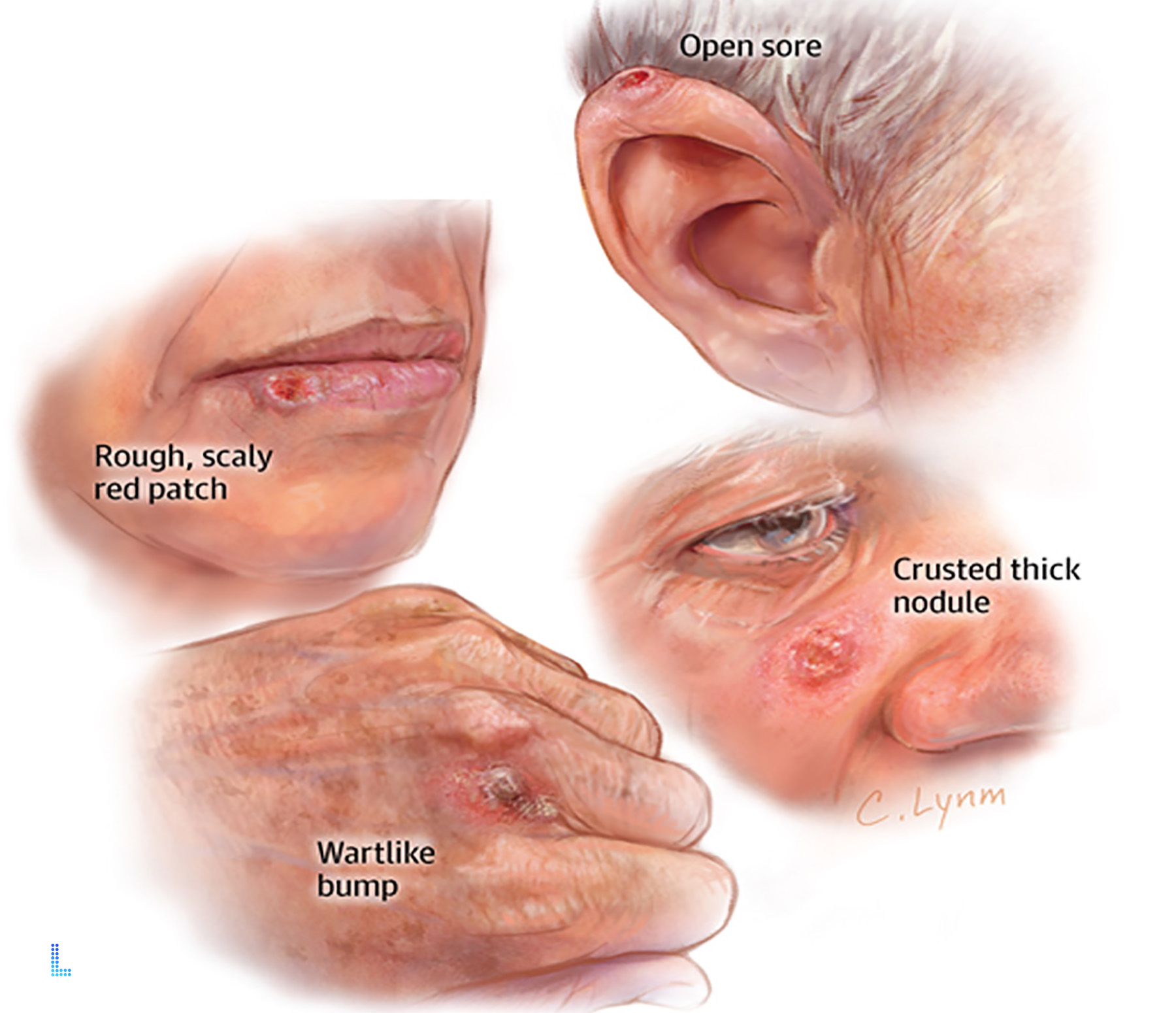 Skin Cancers