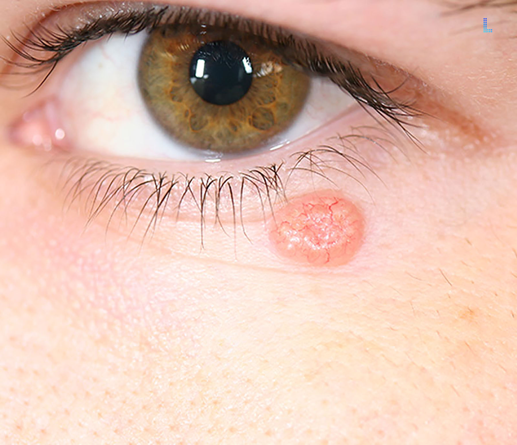 Best Skin Cancers in Lahore