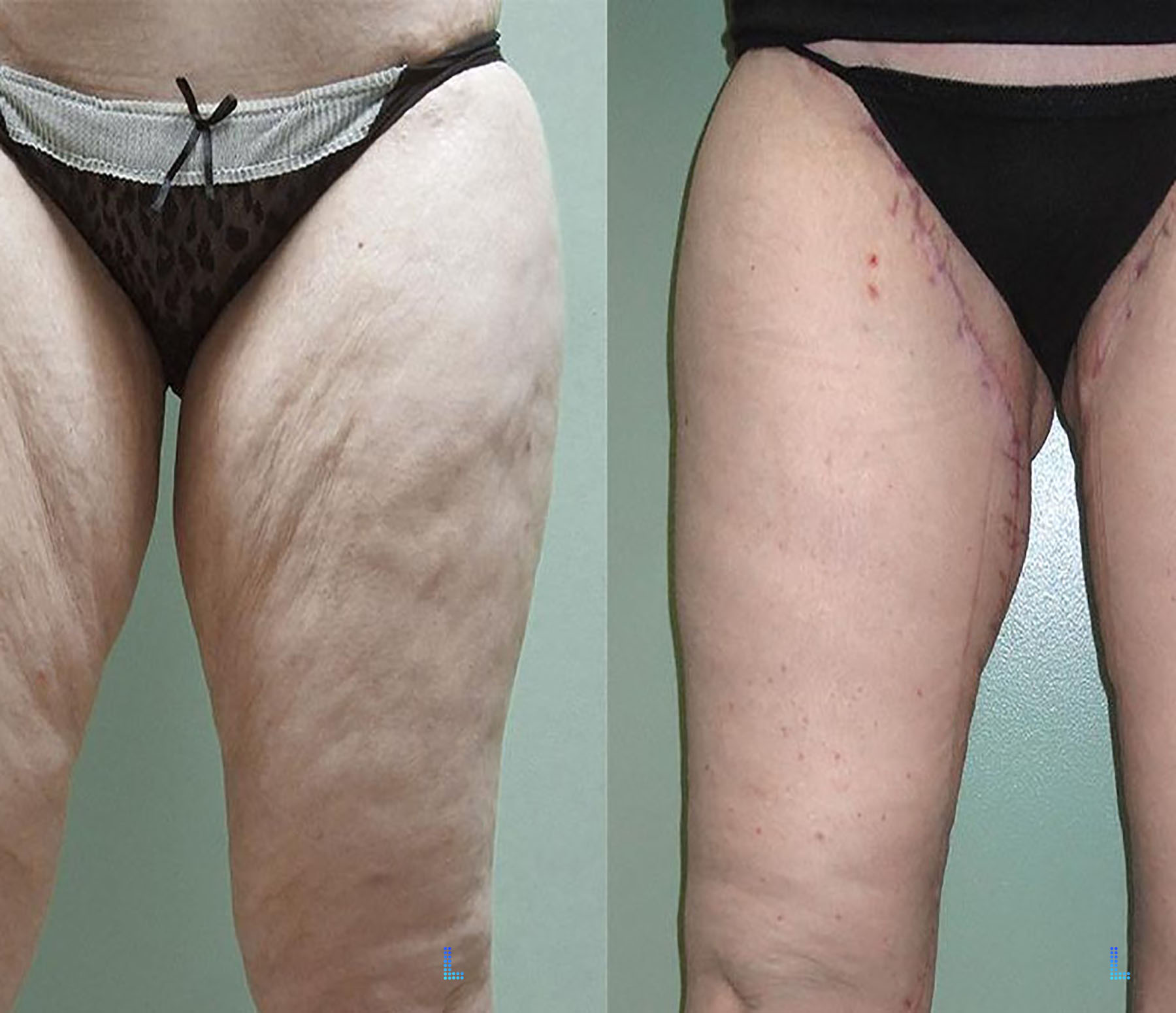 Best Aesthetic Thigh Lift Surgery in Lahore