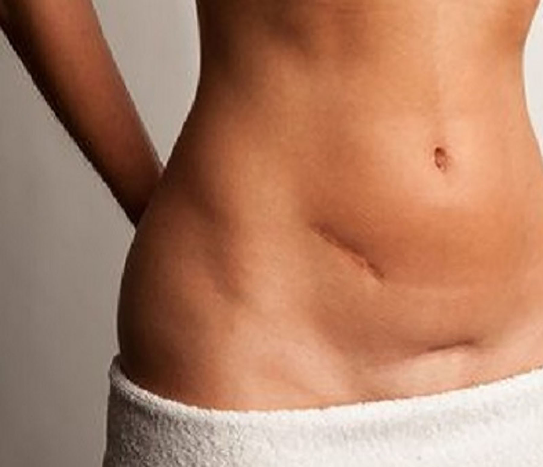 Tummy Tuck