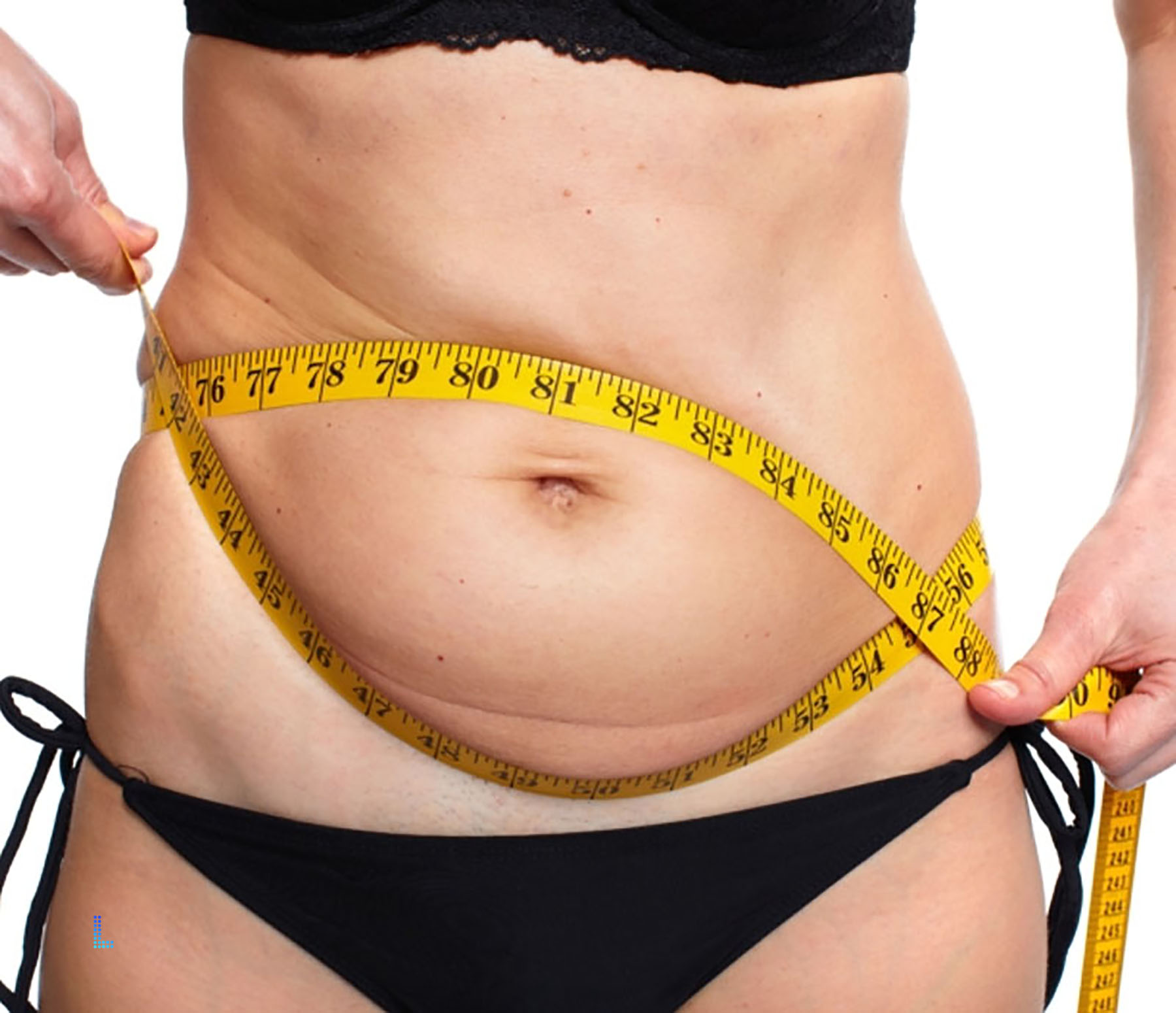 Ideal Liposuction Patients Lahore