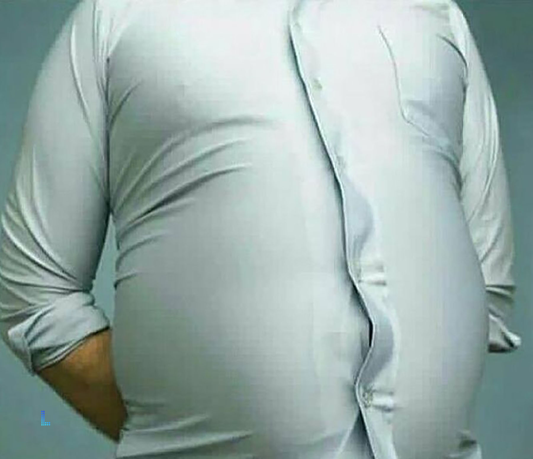 Detail of Gastric Balloon Procedure in Lahore