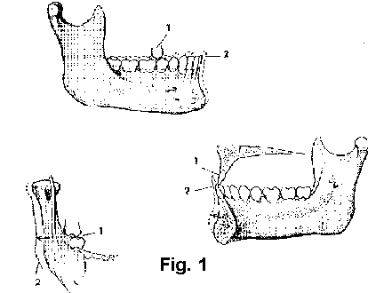 Interferencias oclusales
