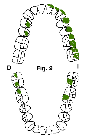 Trayectos oclusales de tallado