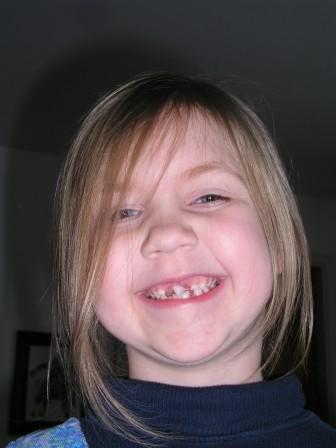 Missing teeth