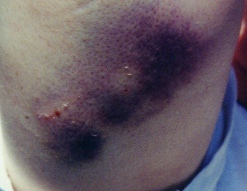 bite1.jpg (20473 bytes)
